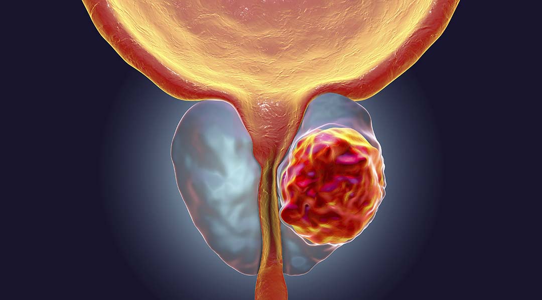 radioterapia recidiva cancer de prostata prostatita de temperatura