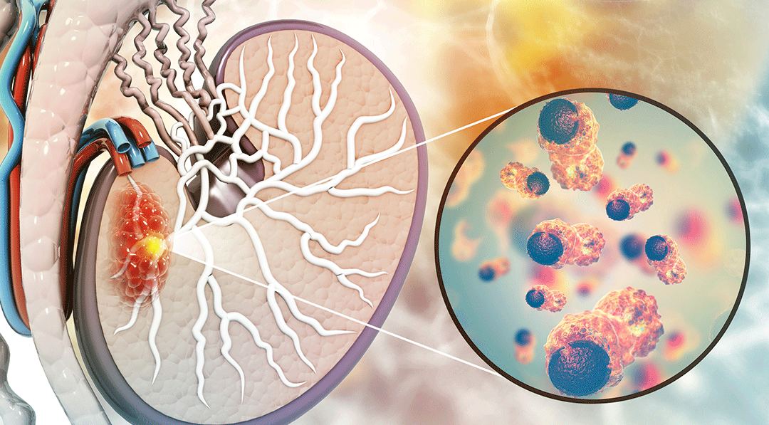 Câncer de testículo: fique atento aos sinais - Dr. Leonardo Ortigara