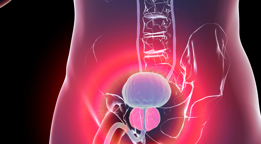 5 vantagens do iTind para remodelação da próstata
